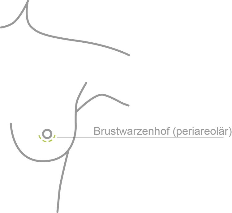 Brustwarzenhofschnitt | periareolär
