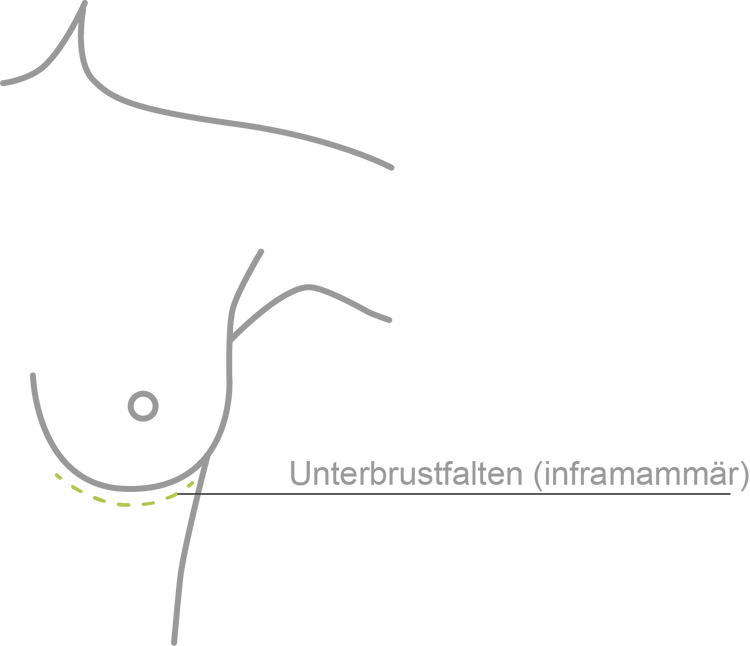 Unterbrustfaltenschnitt | inframammär